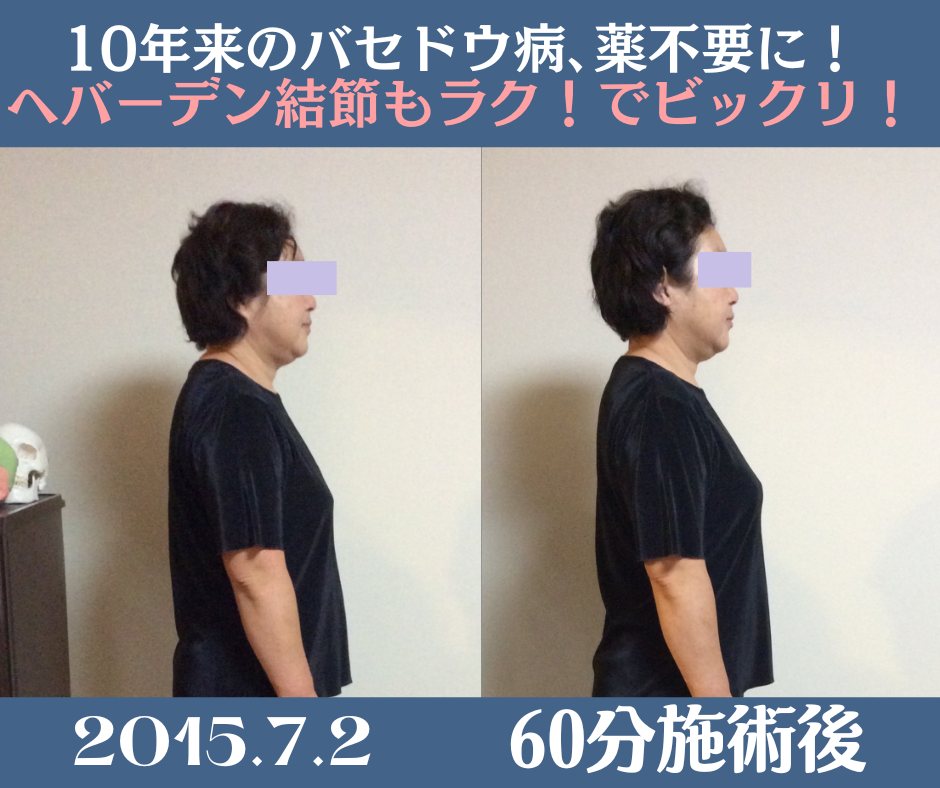 バセドウ病改善