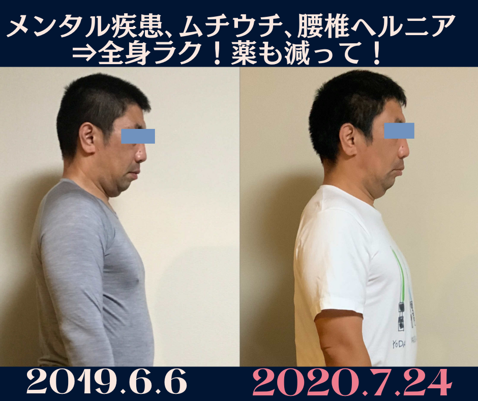 腰痛メンタル疾患改善