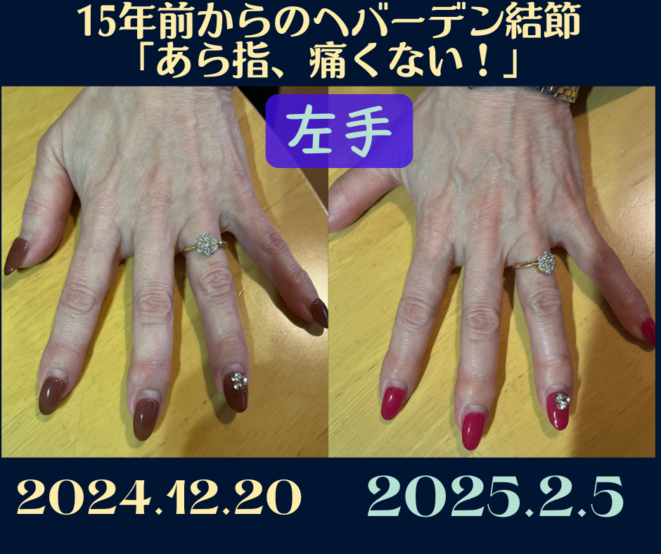 ヘバーデン結節痛くない